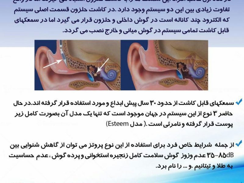 سمعک های کاشتنی